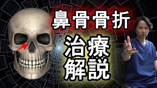 【専門医が解説】鼻骨骨折の治療法【きれいに治すために】