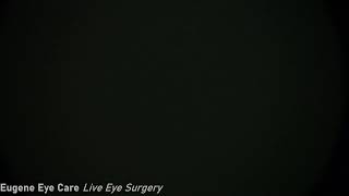 Eugene Eyecare Live Cataract Surgery