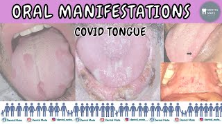 Oral symptoms of COVID-19 | COVID tongue | Geographic tongue | Dr Paridhi Agrawal