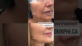 Sofwave Ultrasound Skin Tightening - Got LIFT?