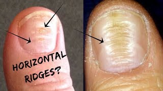 Do You Have These Horizontal Ridges On Your Nails?-Palmistry