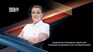 Stomatoloq məsləhəti (5) - uşaqlarda diş cürümələrinin səbəbləri və qarşısının alınması