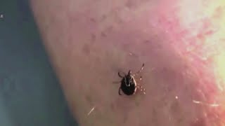 Tickborne Illnesses in New York