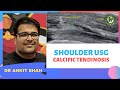 TMT: Calcific Tendinosis by Dr Ankit Shah