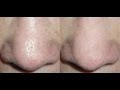 HOW TO MAKE LARGE PORES VANISH IN SECONDS! HOW TO MAKE LARGE PORES VANISH IN SECONDS!