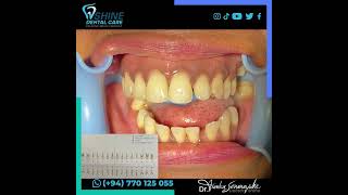 අති නවීන  Invisalign Braces මඟින් දත් අතර හිඩැස් හා ඉදිරියට නෙරා ගිය දත් සැකසෙන හැටි කළින් බලමු.