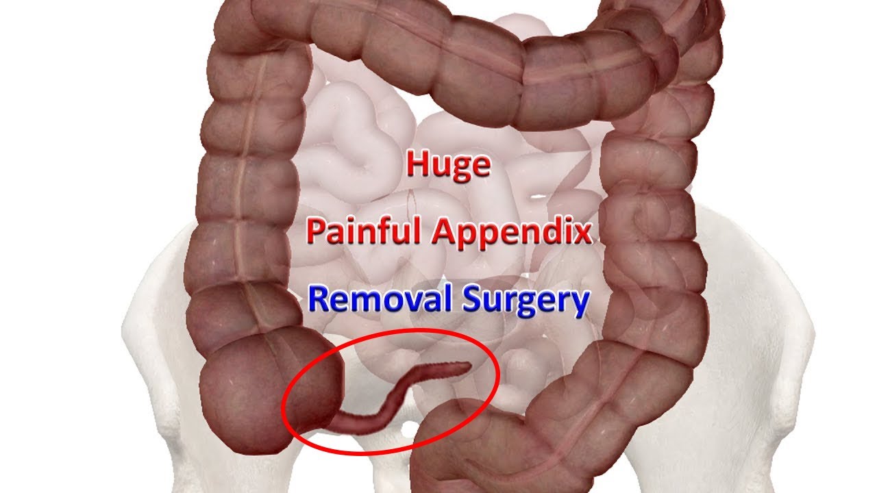 Laparoscopic Appendectomy For Enlarged Appendix Surgical Video | How ...