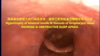 打鼾(打呼)與阻塞型睡眠呼吸中止症 劉耿僚醫師 snoring \u0026 OSAS