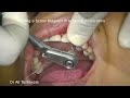 socket shield immediate implant placement maxillary canine. the ultimate tissue preservation tool