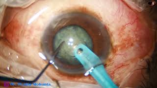 Management of Grade 3 NS cataracts with middilated pupils - Pradip Mohanta, 16th December, 2024