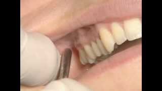 Mandibular Anesthesia - Akinosi Block