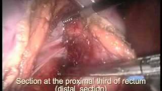 Laparoscopic-Assisted Rectosigmoidectomy with Ileal Loop Interposition. Surgical Treatment of Chaga