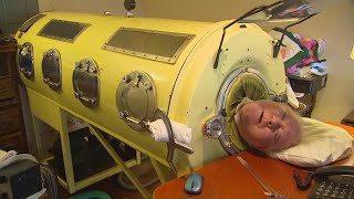 Man who lived in iron lung: Paul Alexander dies at 78