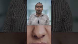 What are Nasal Polyps?  | Dr. Rajesh Vepuri | Cochlea ENT Vijayawada