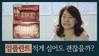 임플란트, 적게 심어도 괜찮을까? 디지털 풀아치로 해결!