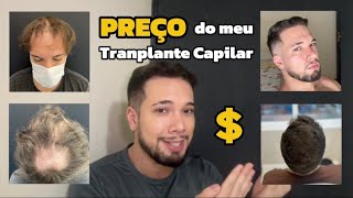 QUANTO CUSTOU o meu TRANSPLANTE CAPILAR