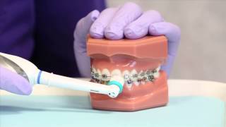 Brushing your braces with a power brush
