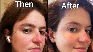 Red Light Therapy  Before and After - Real Life Results