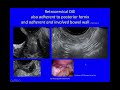 6 12 abcdendometriosis retrocervical nodules die involving posterior vaginal fornix lower rectum