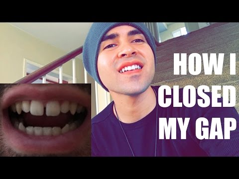 Closing Gap with Rubber Bands Closing Gap with Rubber Bands