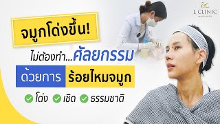 รีวิว : ร้อยไหมจมูก จมูกโด่งไม่ต้องเสริม ดูธรรมชาติ  By หมออรLclinic ❤️