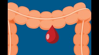 Endoscopic Management of Upper GI Bleed A Review