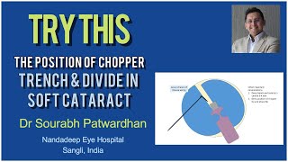 229 Position of tip of the chopper for trench \u0026 divide in Soft cataract : Dr Sourabh Patwardhan