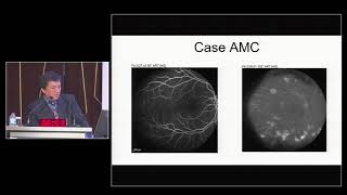 Optical Coherence Tomography Angiography (OCT-A): Diabetic Retinopathy