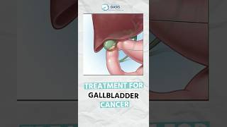 Treatment Options for Gallbladder Cancer | Dr Aditya Kulkarni #dradityakulkarni #cancercure #shorts