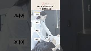 출산 후 늘어진 뱃살을 쫙 붙여주는 시술