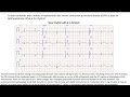 sinus rhythm with 2 1 av block ecg wave maven case 368