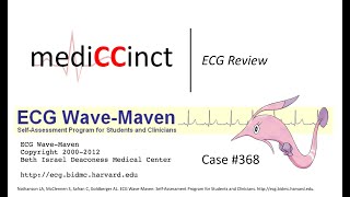 Sinus Rhythm With 2:1 AV Block (ECG Wave-Maven) Case #368