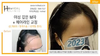 [모힐TV] 👩🏻‍🦰 여성 모발이식 / 2,700모 깊은 M자 + 헤어라인 교정 비절개수술 12개월 경과 💆🏻‍♀️