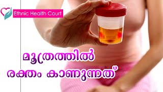 മൂത്രത്തില്‍ ചോര വൃക്ക കാന്‍സർ ആകാം | Kidney Cancer | Ethnic Health Court