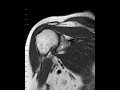 Adhesive capsulitis