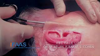 IFAAS Exclusive Techniques - ABC Face Lift by Dr. Steven R. Cohen