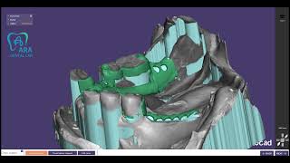 lower partial frame design  Lingoplate