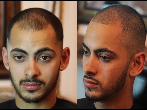 How To Fix Receding Hairline Naturally | No Pills, Spray Enhancements or tattoos How To Fix Receding Hairline Naturally | No Pills, Spray Enhancements or tattoos