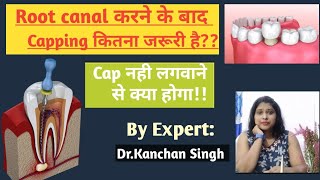 RCT के बाद cap लगाना चाहिए या नहीं /rct के बाद capping kyu/Dr. Kanchan Singh