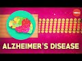 What is Alzheimer's disease? - Ivan Seah Yu Jun What is Alzheimer's disease? - Ivan Seah Yu Jun
