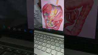 Revisione di Sleeve Gastrectomy parte 2