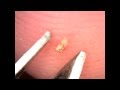 Nasty Splinter Removal