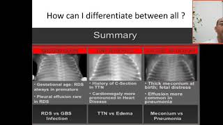 How to differentiate between common lung disease in neonates by CXR? RDS,GBS, TTN, MAS, PNEUMONIA, E