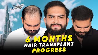 Hair Transplant in Dubai | Best Results & Cost of Hair Transplant in Dubai