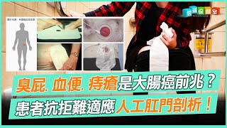 臭屁.血便.痔瘡是大腸癌前兆？ 患者抗拒難適應 人工肛門剖析!｜雲端保健室 EP2精華