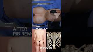 Transgender Rib Remodeling with 360 Liposuction \u0026 Brazilian Butt Lift (BBL) Body Feminization!