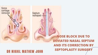 Nose block corrected by SEPTOPLASTY.. മൂക്കിൻ്റെ പാലത്തിൻ്റെ വളവ് ശെരി ആക്കിയപ്പോൾ...