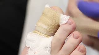 Ingrown Toenail Removal: Matrixectomy Procedure