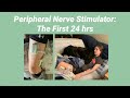 Peripheral Nerve Stimulater: Surgery & Device Recap