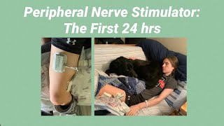 Peripheral Nerve Stimulater: Surgery \u0026 Device Recap